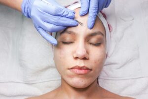 Rahasia 3 Treatment Dokter Ampuh Atasi Jerawat Membandel