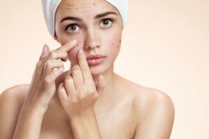 Suka Gorengan & Manis? Waspadai Jerawat Membandel!