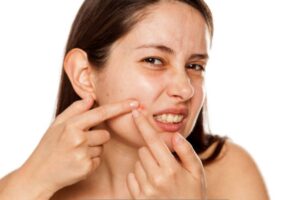 Bahaya Memencet Jerawat? Dokter Ungkap Fakta Mengejutkan Kulit